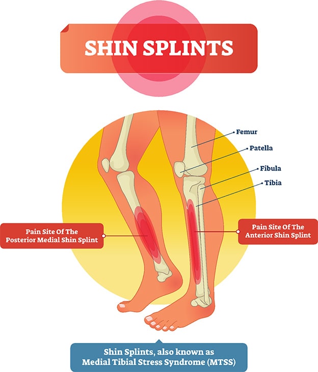 What Can I Do to Help My Shin Splints? 