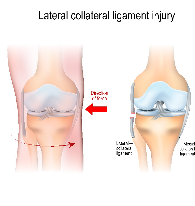 What Causes Lateral Knee Pain?