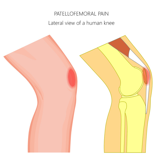 What Causes Lateral Knee Pain?