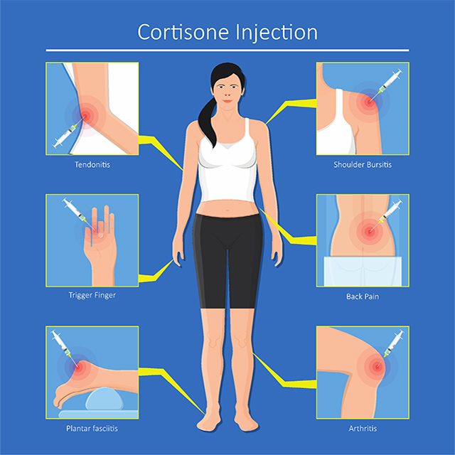 2 Things You Must Know About Corticosteroid Injections
