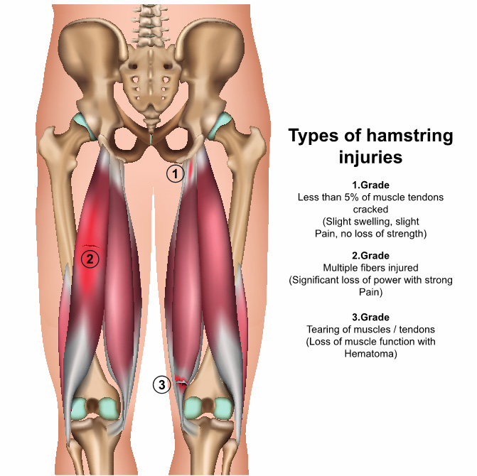 How to Predict a Hamstring Injury in AFL