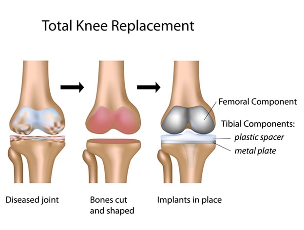 What to Expect After Knee Replacement Surgery