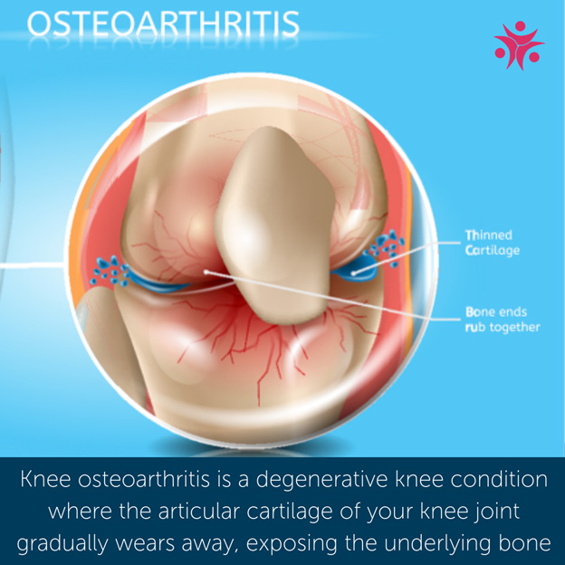 Osteoarthritis Exercises for Knee Pain