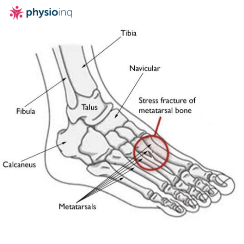 Stress Fractures Foot 