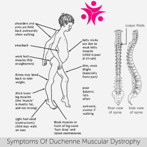 Duchenne Muscular Dystrophy Prevention And Treatment